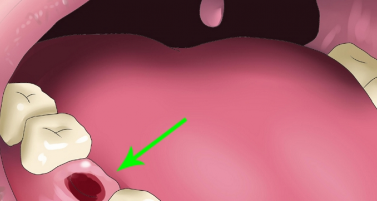Mẹo lợi hại giúp răng mọc lại mà không cần hàn răng hay trồng răng giả